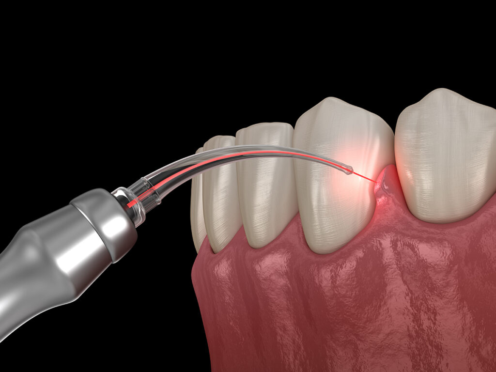 laser periodontal therapy Scottsdale