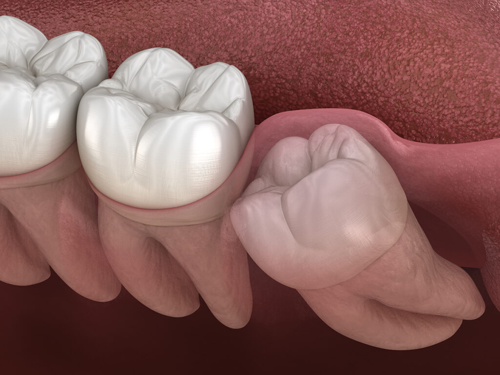 wisdom teeth removal Scottsdale AZ