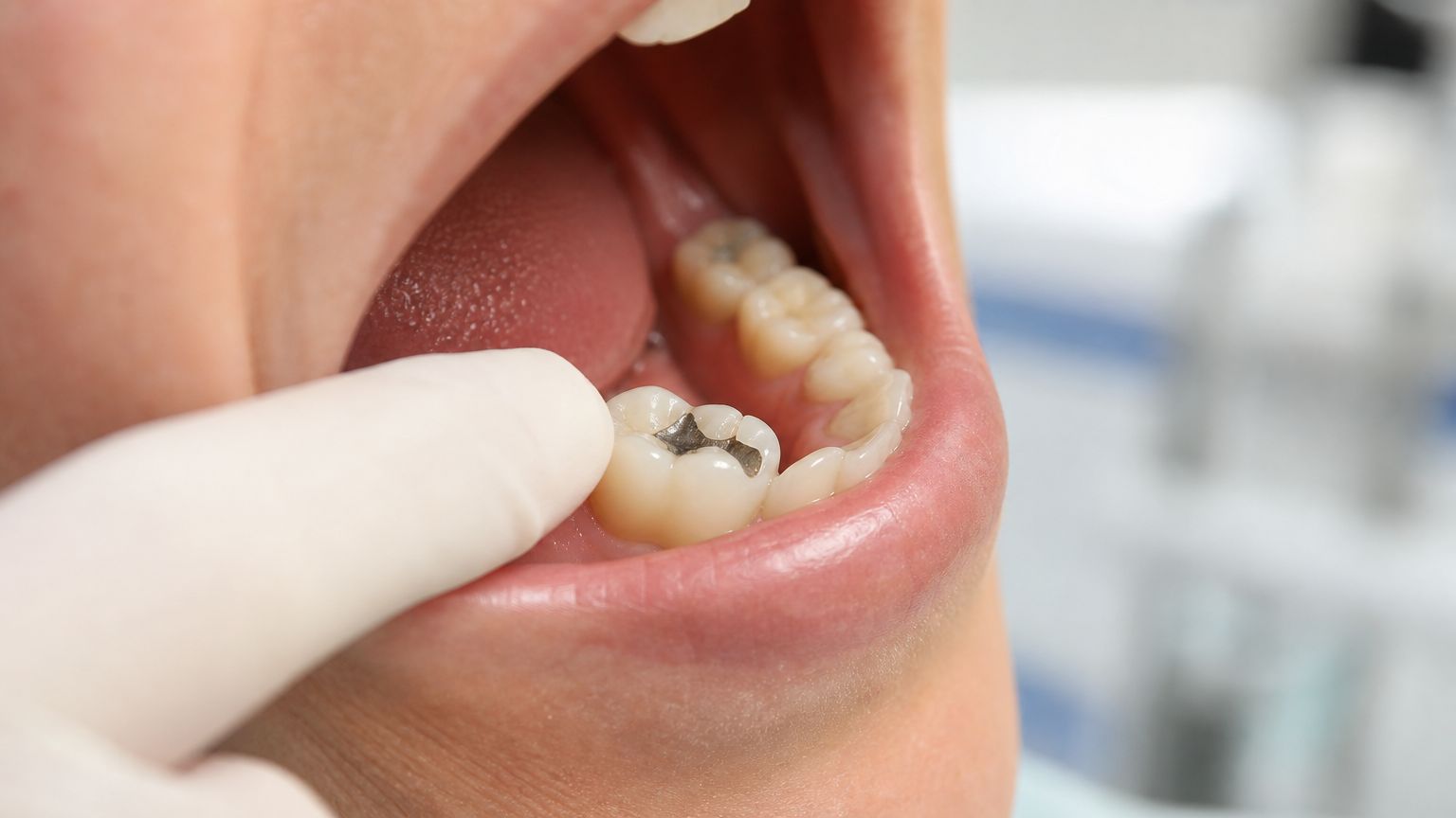 Trinity Dental Blogs 58 broken tooth filling dental