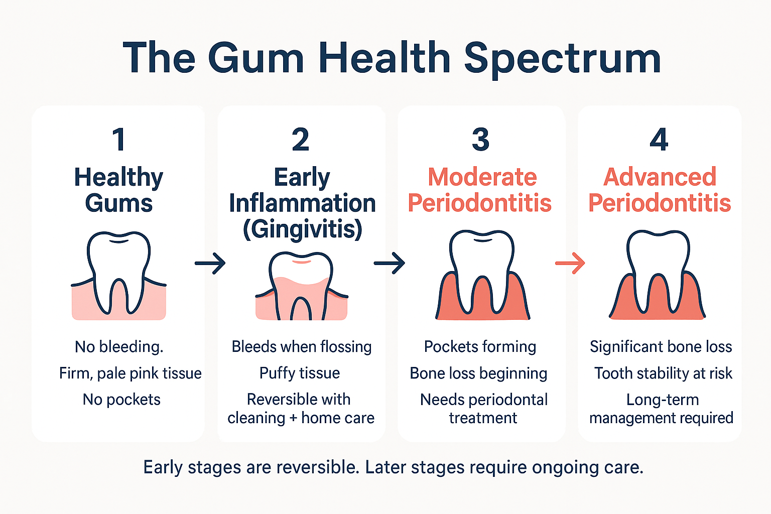 Your Gums Bleed When You Floss. Here Is When That Is a Warning Sign. 2 Infographic showing four stages of gum health from healthy tissue to advanced periodontitis with descriptions of each stage